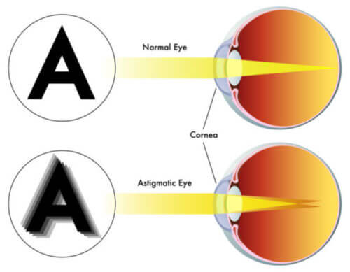 Astigmatism