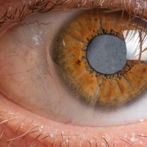 Causes of Cataracts