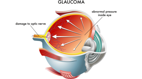 Glaucoma causes