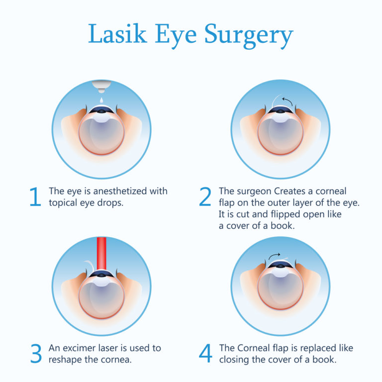 lasik