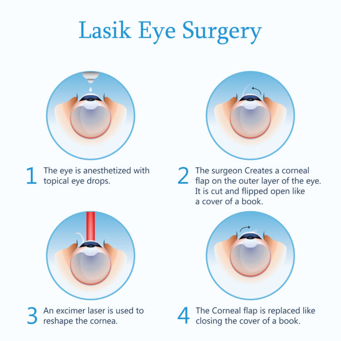 Lasik Eye surgery procedure