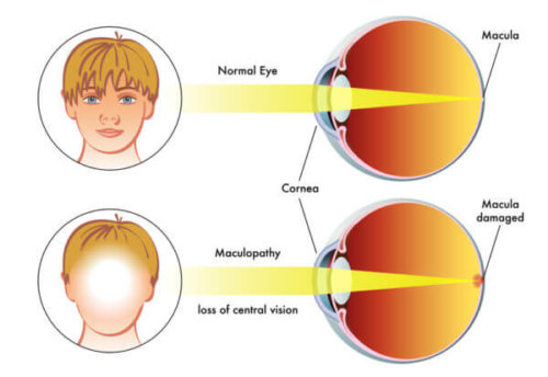 Macular Degeneration