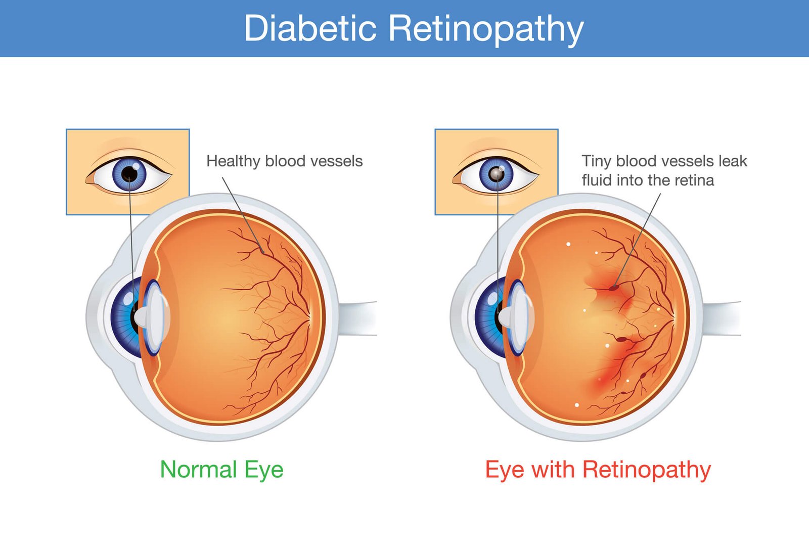 Diabetic Retinopathy Explained: Everything You Need To Know | Eye Pain ...
