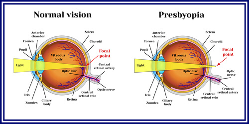 Normal Vision and Presbyopia