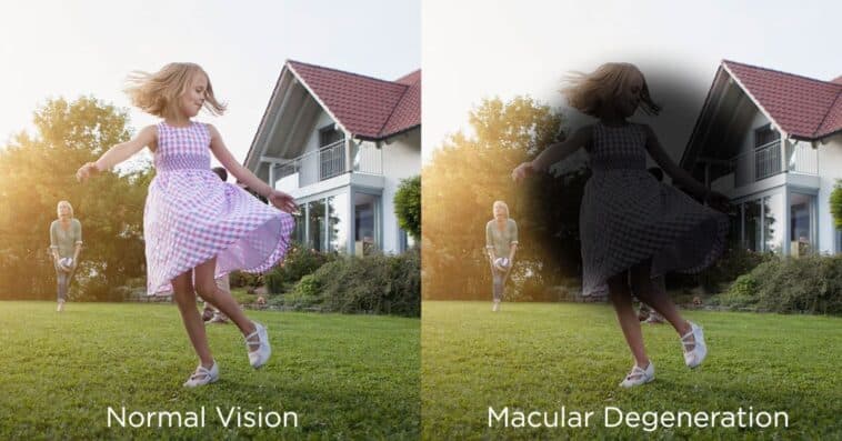 What Is Age-Related Macular Degeneration