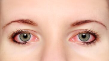 How Long is Pink Eye Contagious.j