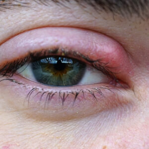 how to get rid of a stye