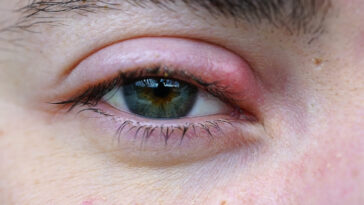 how to get rid of a stye