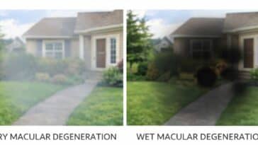 wet vs dry macular degeneration