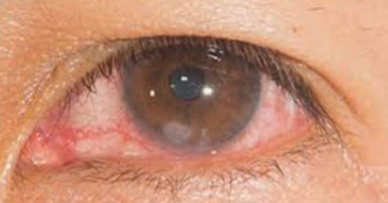 Corneal Abrasion