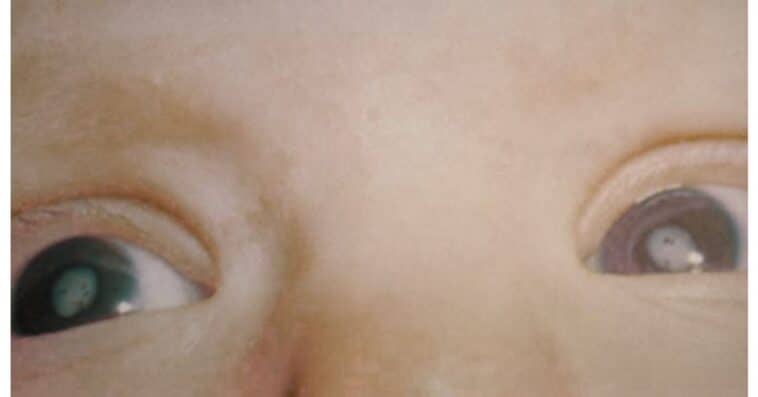 Congenital Cataracts