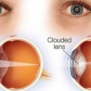 Early Cataract Symptoms