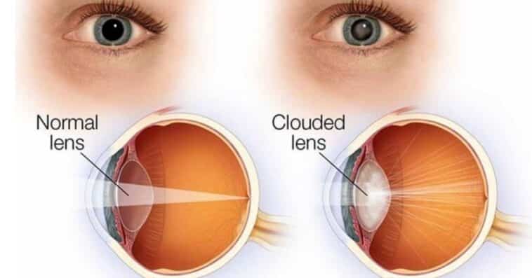 Early Cataract Symptoms